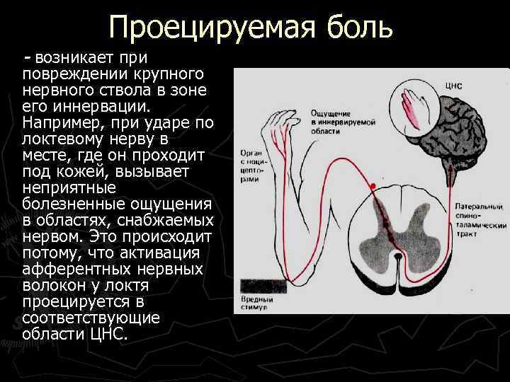 Проецируемая боль - возникает при повреждении крупного нервного ствола в зоне его иннервации. Например,