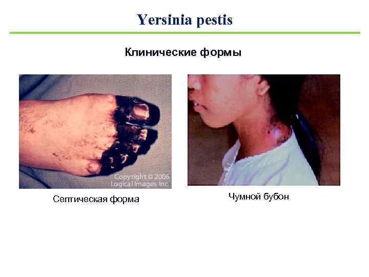 Yersinia pestis Клинические формы Септическая форма Чумной бубон 