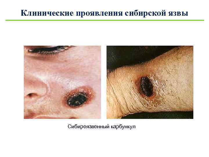 Клинические проявления сибирской язвы Сибиреязвенный карбункул 
