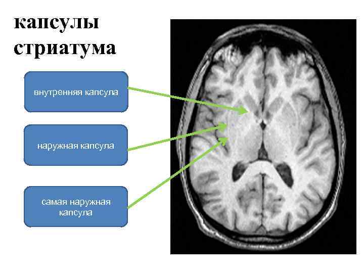 капсулы стриатума внутренняя капсула наружная капсула самая наружная капсула 