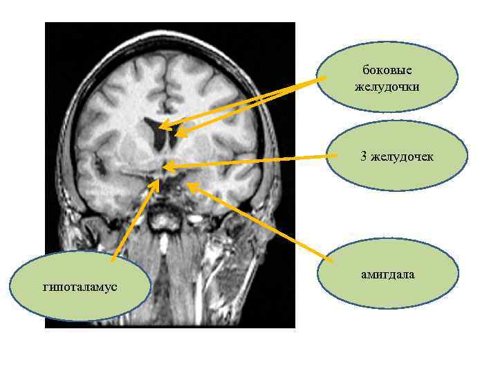 боковые желудочки 3 желудочек гипоталамус амигдала 