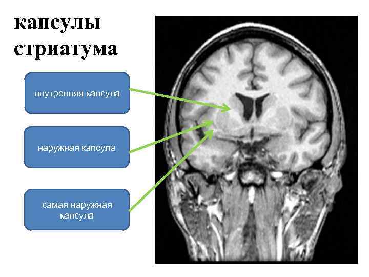 капсулы стриатума внутренняя капсула наружная капсула самая наружная капсула 