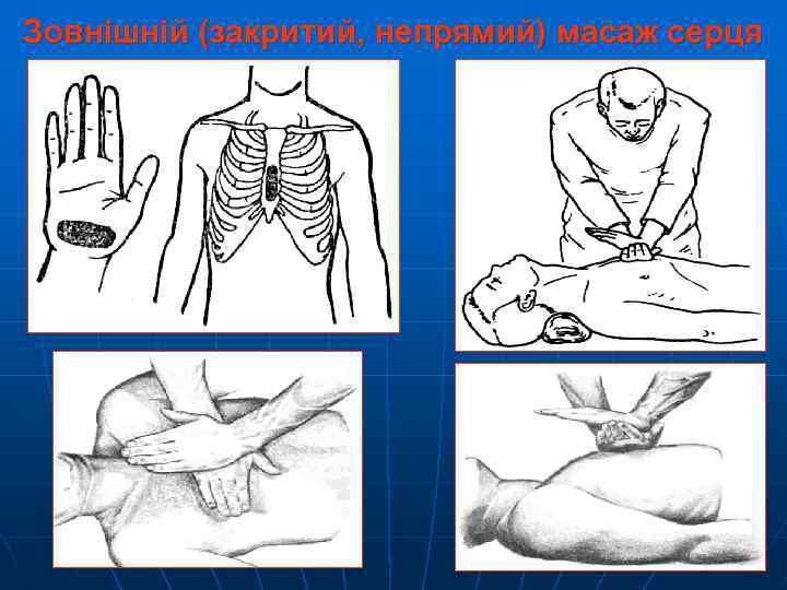 Зовнішній (закритий, непрямий) масаж серця 