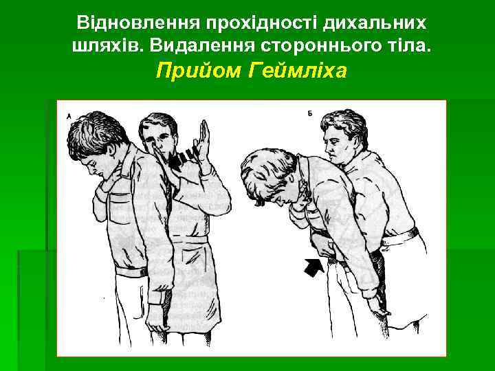 Відновлення прохідності дихальних шляхів. Видалення стороннього тіла. Прийом Геймліха 