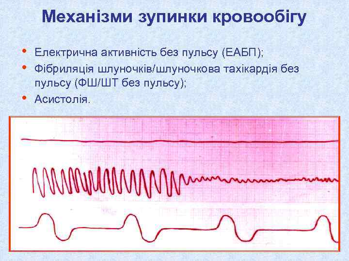 Механізми зупинки кровообігу • • • Електрична активність без пульсу (ЕАБП); Фібриляція шлуночків/шлуночкова тахікардія