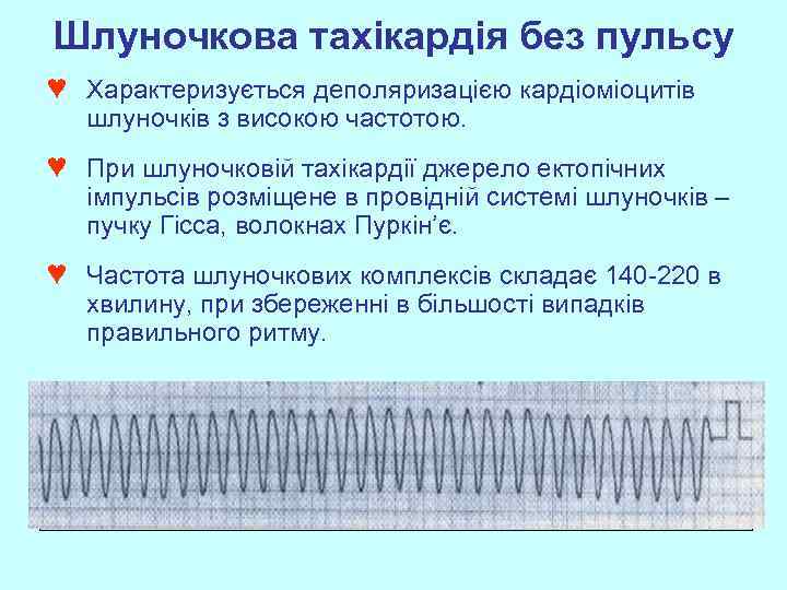 Шлуночкова тахікардія без пульсу ♥ Характеризується деполяризацією кардіоміоцитів шлуночків з високою частотою. ♥ При