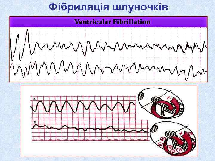 Фібриляція шлуночків 