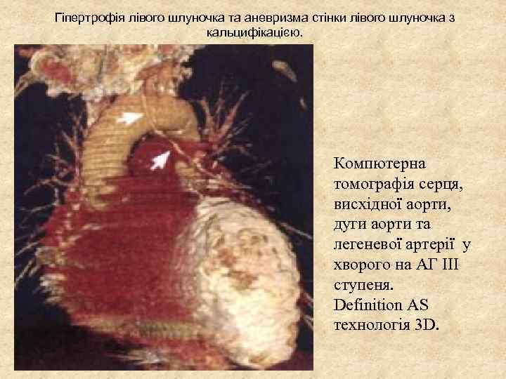 Гіпертрофія лівого шлуночка та аневризма стінки лівого шлуночка з кальцифікацією. Компютерна томографія серця, висхідної