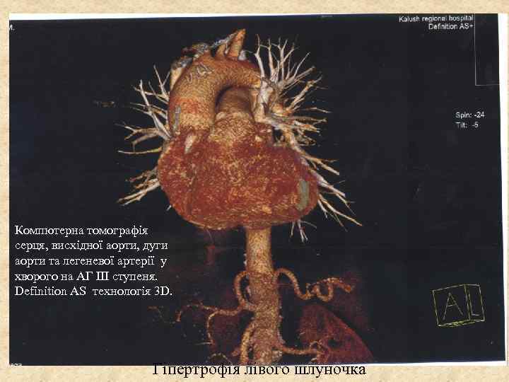 Компютерна томографія серця, висхідної аорти, дуги аорти та легеневої артерії у хворого на АГ
