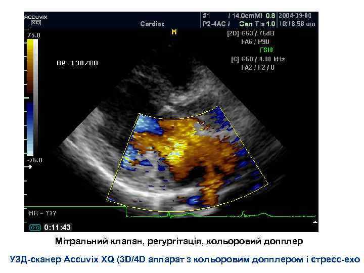 Мітральний клапан, регургітація, кольоровий допплер УЗД-сканер Accuvix XQ (3 D/4 D аппарат з кольоровим
