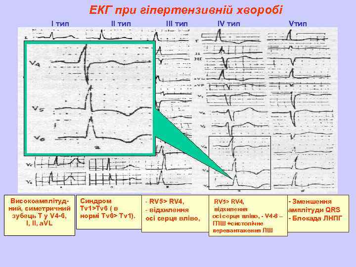 ЕКГ при гіпертензивній хворобі І тип Високоамплітудний, симетричний зубець Т у V 4 -6,
