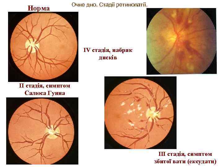 Норма Очне дно. Стадії ретинопатії. ІV стадія, набряк дисків ІІ стадія, симптом Салюса Гунна