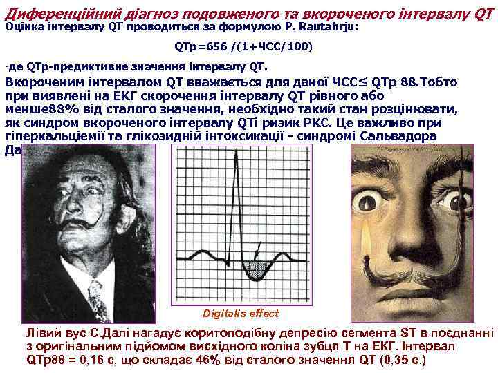 Диференційний діагноз подовженого та вкороченого інтервалу QT Оцінка інтервалу QT проводиться за формулою P.