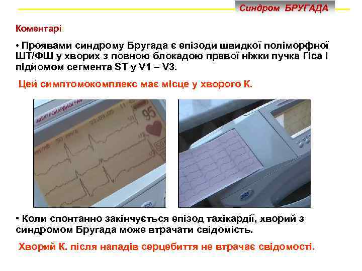 Синдром БРУГАДА Коментарі: • Проявами синдрому Бругада є епізоди швидкої поліморфної ШТ/ФШ у хворих