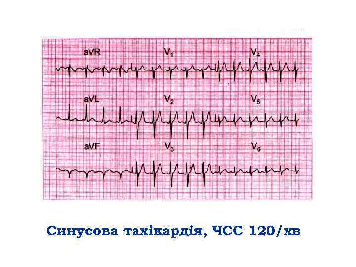 Синусова тахікардія, ЧСС 120/хв 