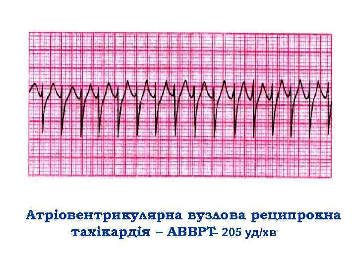 Атріовентрикулярна вузлова реципрокна тахікардія – АВВРТ – 205 уд/хв 