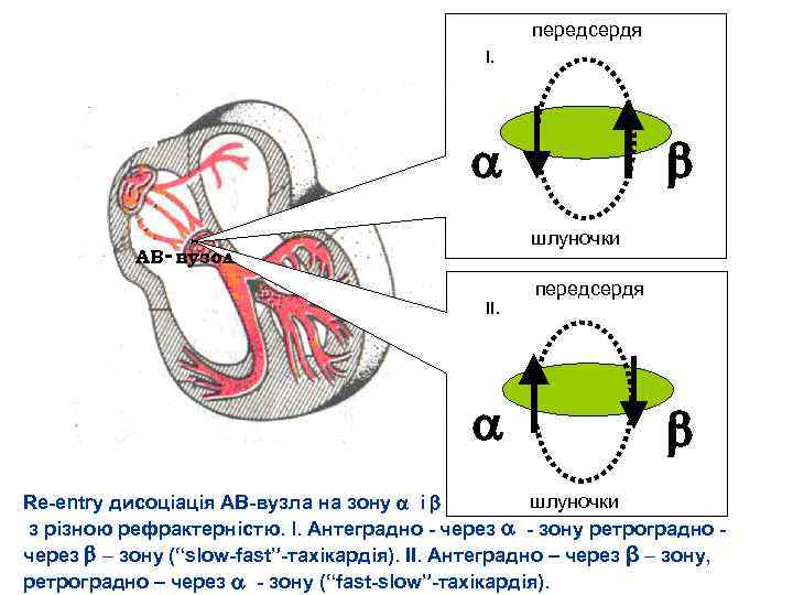 передсердя I. шлуночки АВ- вузол II. передсердя шлуночки Re entry дисоціація АВ вузла на