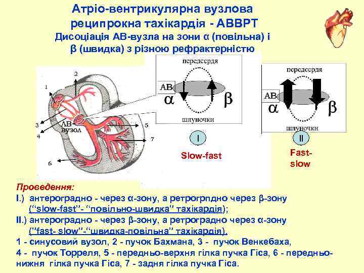 Атріо вентрикулярна вузлова реципрокна тахікардія АВВРТ Дисоціація АВ вузла на зони α (повільна) і