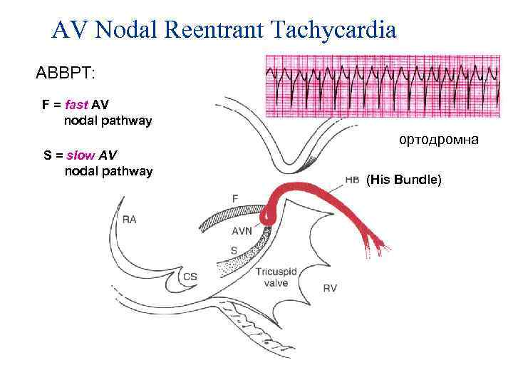 AV Nodal Reentrant Tachycardia АВВРТ: F = fast AV nodal pathway ортодромна S =