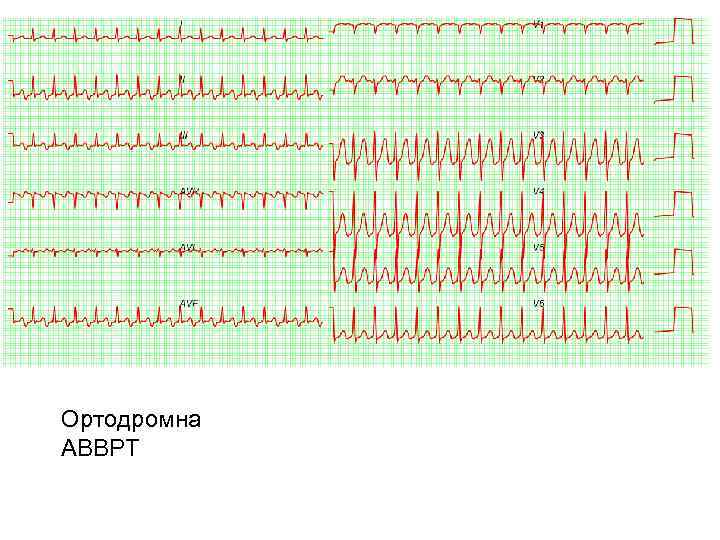 Ортодромна АВВРТ 