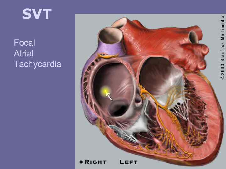SVT Focal Atrial Tachycardia 