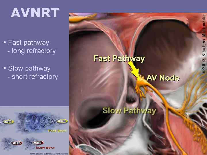 AVNRT • Fast pathway - long refractory • Slow pathway - short refractory 