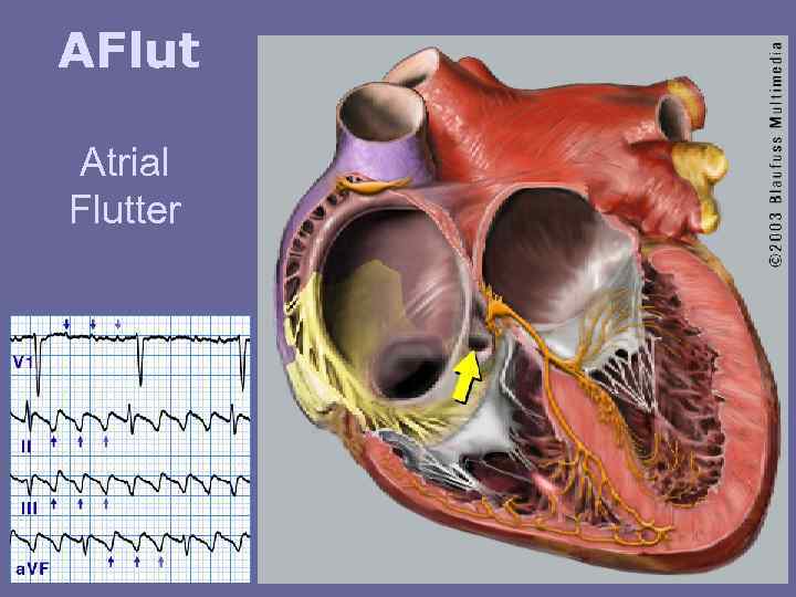 AFlut Atrial Flutter 