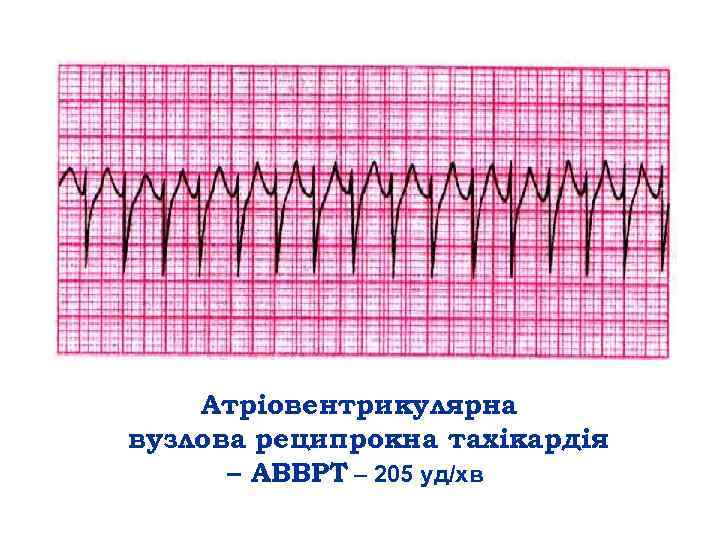 Атріовентрикулярна вузлова реципрокна тахікардія – АВВРТ – 205 уд/хв 