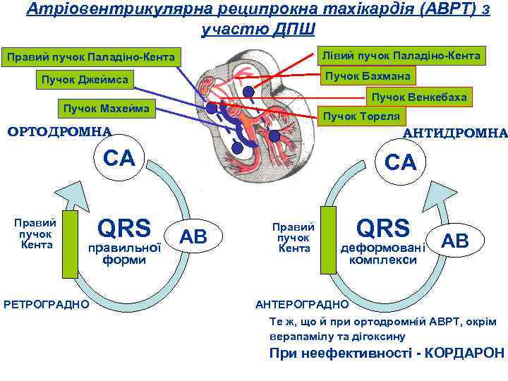 Атріовентрикулярна реципрокна тахікардія (АВРТ) з участю ДПШ Лівий пучок Паладіно Кента Правий пучок Паладіно