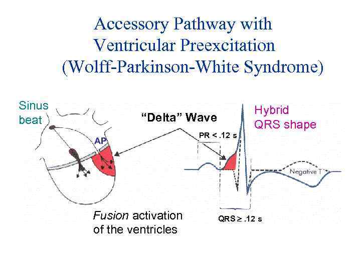 Accessory Pathway with Ventricular Preexcitation (Wolff-Parkinson-White Syndrome) Sinus beat “Delta” Wave AP Fusion activation
