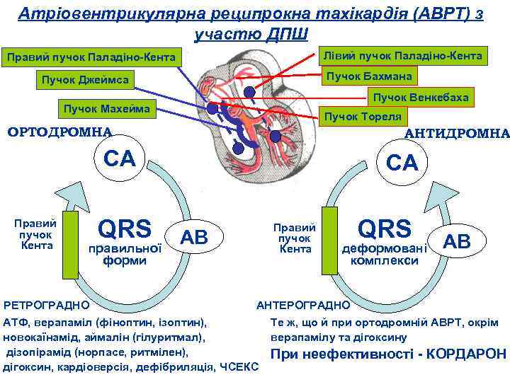 Атріовентрикулярна реципрокна тахікардія (АВРТ) з участю ДПШ Лівий пучок Паладіно Кента Правий пучок Паладіно