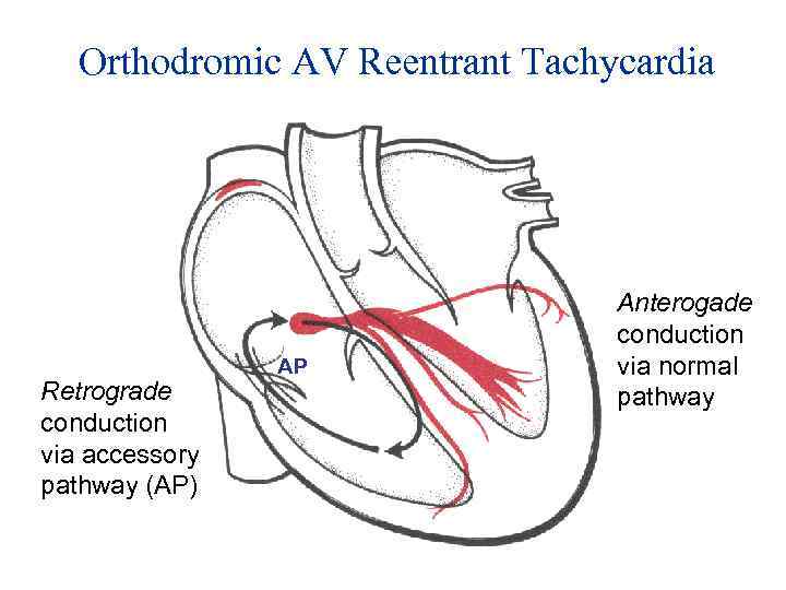 Orthodromic AV Reentrant Tachycardia Retrograde conduction via accessory pathway (AP) AP Anterogade conduction via