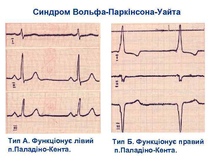 Синдром Вольфа Паркінсона Уайта Тип А. Функціонує лівий п. Паладіно Кента. Тип Б. Функціонує