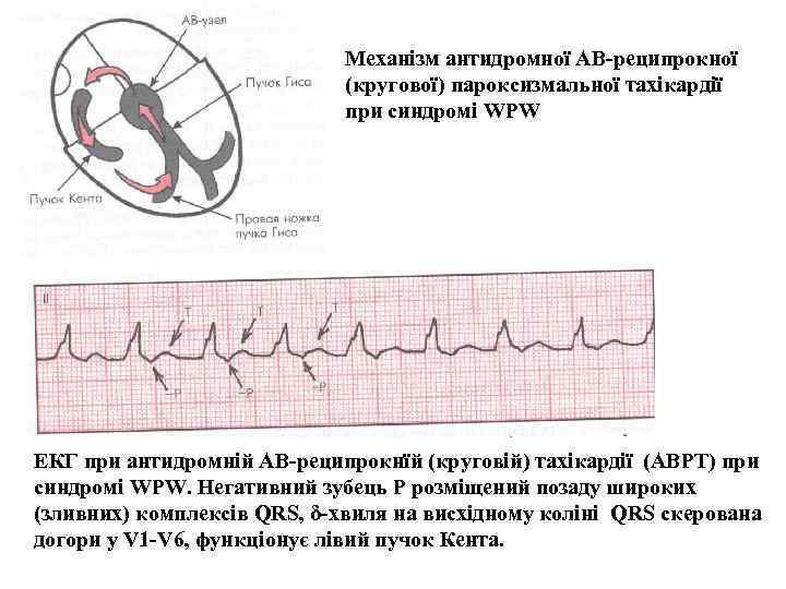 Механізм антидромної АВ-реципрокної (кругової) пароксизмальної тахікардії при синдромі WPW ЕКГ при антидромній АВ-реципрокнїй (круговій)