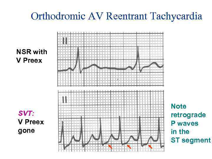 Orthodromic AV Reentrant Tachycardia NSR with V Preex SVT: V Preex gone Note retrograde