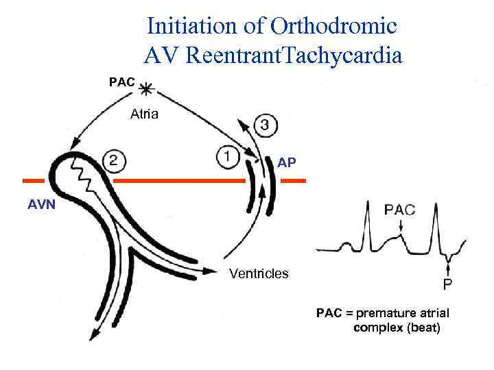 Initiation of Orthodromic AV Reentrant. Tachycardia PAC Atria AP AVN Ventricles PAC = premature