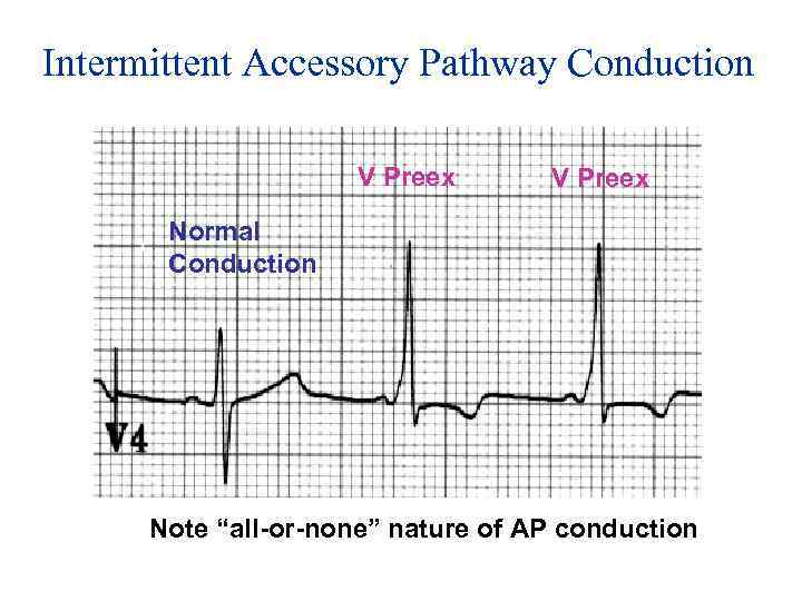 Intermittent Accessory Pathway Conduction V Preex Normal Conduction Note “all or none” nature of