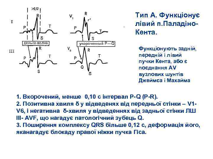 Тип А. Функціонує лівий п. Паладіно Кента. Функціонують задній, передній і лівий пучки Кента,