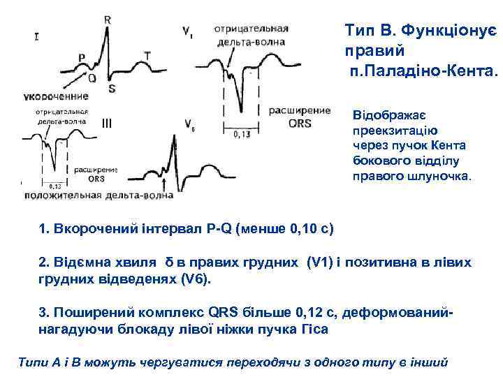 Тип В. Функціонує правий п. Паладіно Кента. ІІІ Відображає преекзитацію через пучок Кента бокового