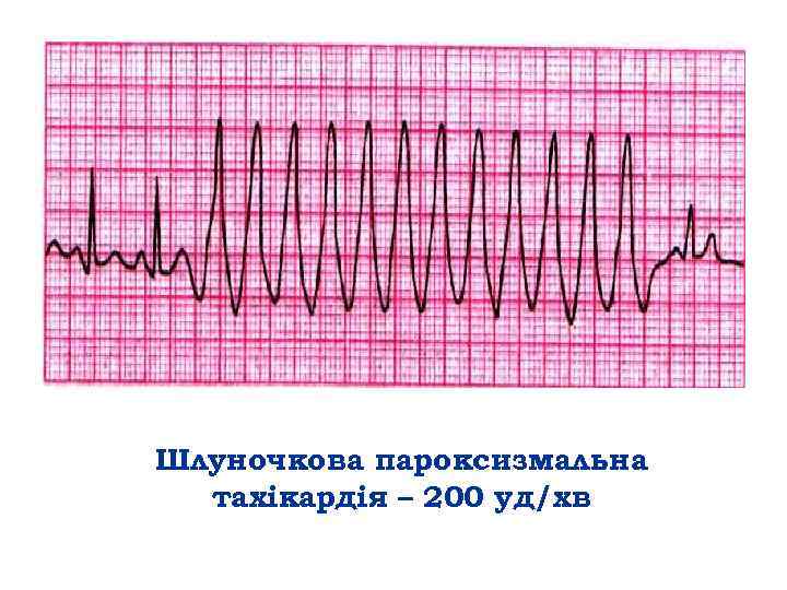 Шлуночкова пароксизмальна тахікардія – 200 уд/хв 