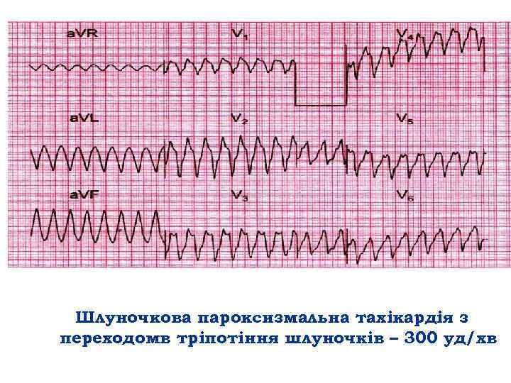 Шлуночкова пароксизмальна тахікардія з переходомв тріпотіння шлуночків – 300 уд/хв 