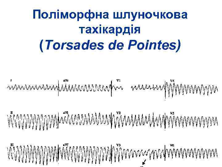 Поліморфна шлуночкова тахікардія (Torsades de Pointes) 