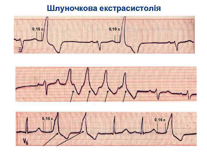 Шлуночкова екстрасистолія 0, 10 с Бігеменія II клас групова екстрасистолія – IV Б клас