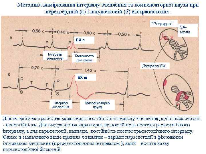 Методика вимірювання інтервалу зчеплення та компенсаторної паузи при передсердній (а) і шлуночковій (б) екстрасистолах.