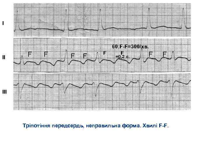 60: F F=300/хв. F F =0, 2 c. F F Тріпотіння передсердь, неправильна форма.