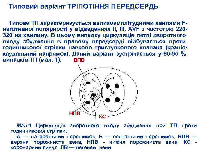 Типовий варіант ТРІПОТІННЯ ПЕРЕДСЕРДЬ Типове ТП характеризується великоамплітудними хвилями F негативної полярності у відведеннях