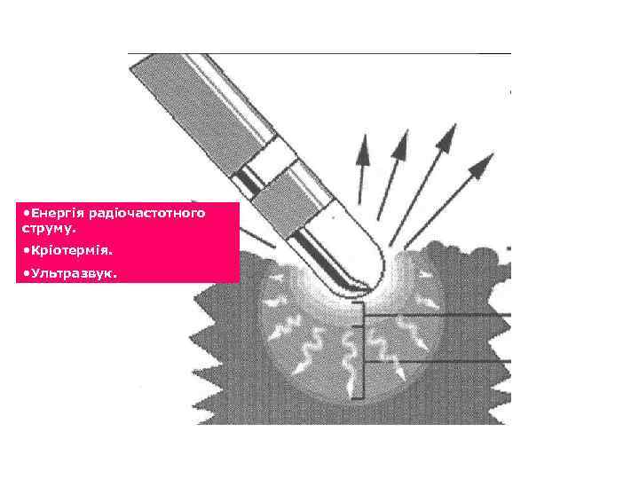  • Енергія радіочастотного струму. • Кріотермія. • Ультразвук. 