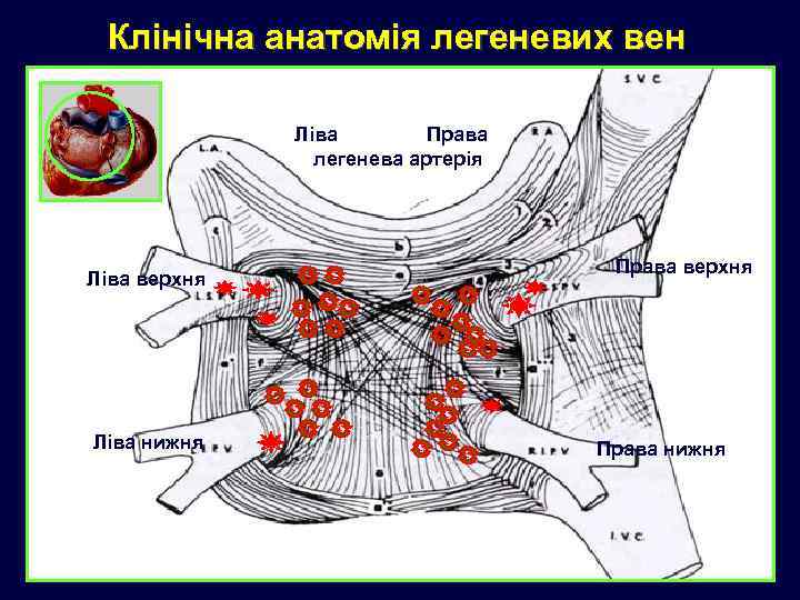Клінічна анатомія легеневих вен Права Ліва легенева артерія Ліва верхня Ліва нижня Права верхня