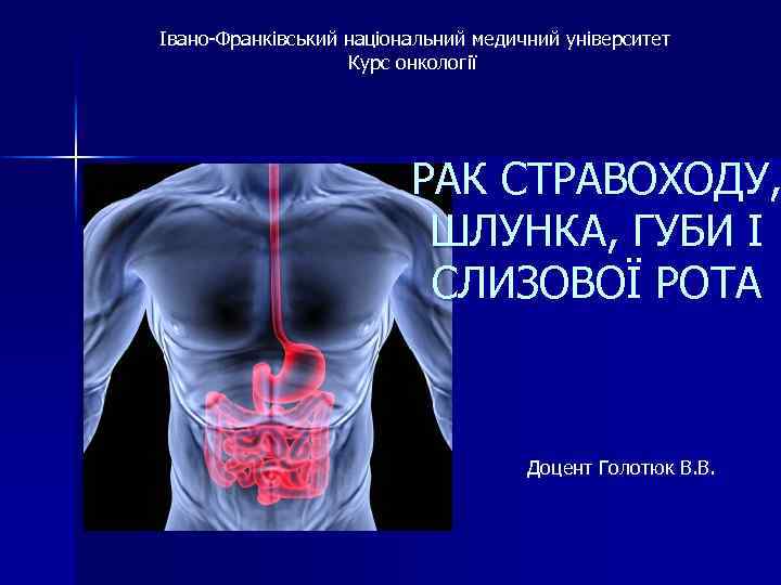 Івано-Франківський національний медичний університет Курс онкології РАК СТРАВОХОДУ, ШЛУНКА, ГУБИ І СЛИЗОВОЇ РОТА Доцент