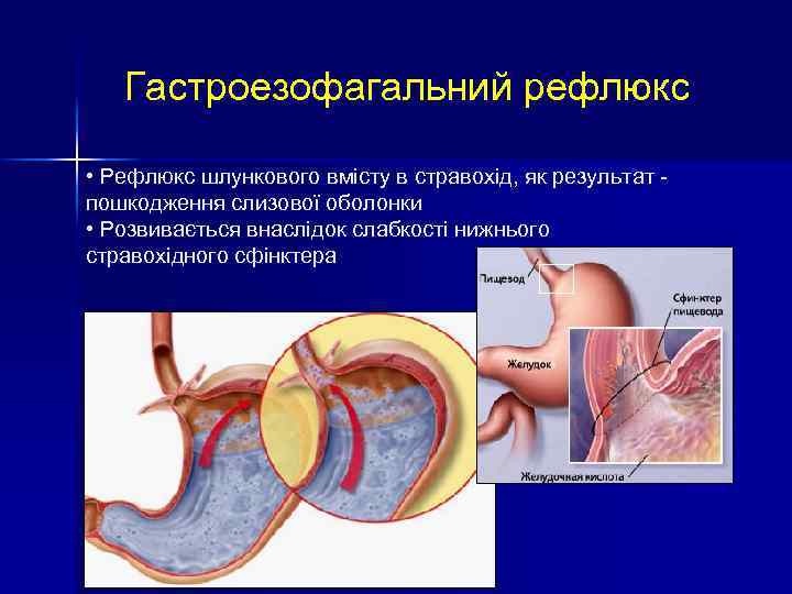 Гастроезофагальний рефлюкс • Рефлюкс шлункового вмісту в стравохід, як результат - пошкодження слизової оболонки